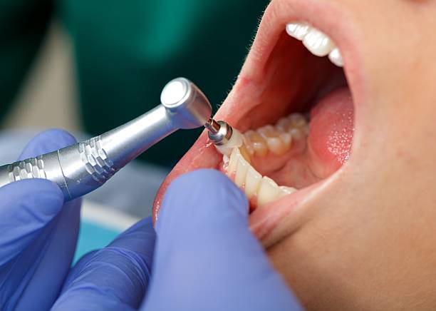 Laser Dentistry in Land O Lakes, FL